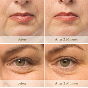 Before and after comparison shots of a woman's lip area and under-eye area. 