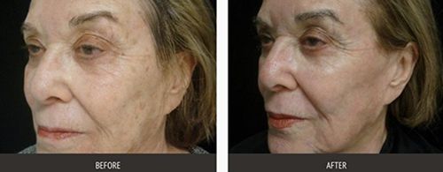 A woman's face before and after hyperpigmentation laser treatment.