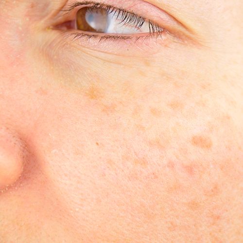 A close-up of woman with hyperpigmentation.