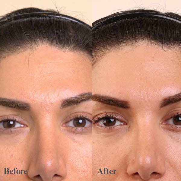 Closeup of Sherry's forehead before and after