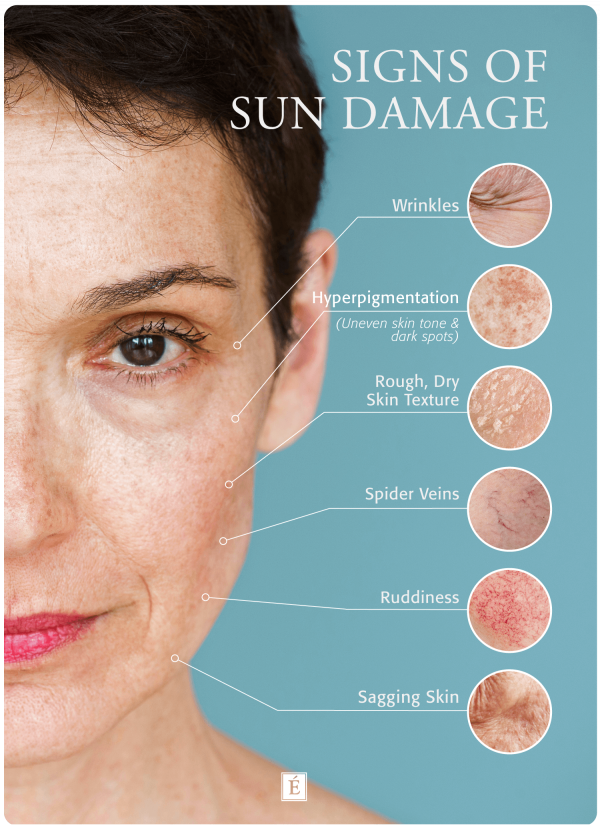 Signs of sun damage