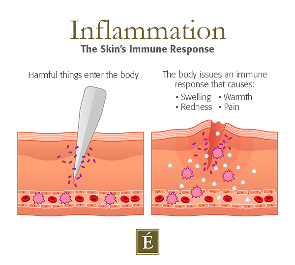 Infographic: Inflammation - The Skin's Immune Response