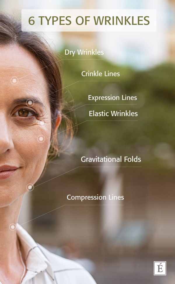 6 Types of Wrinkles infographic