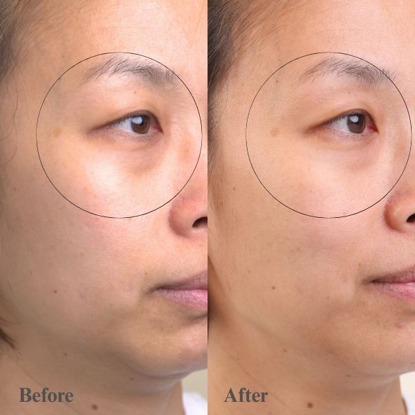 Choo closeup of eye area with before and after image