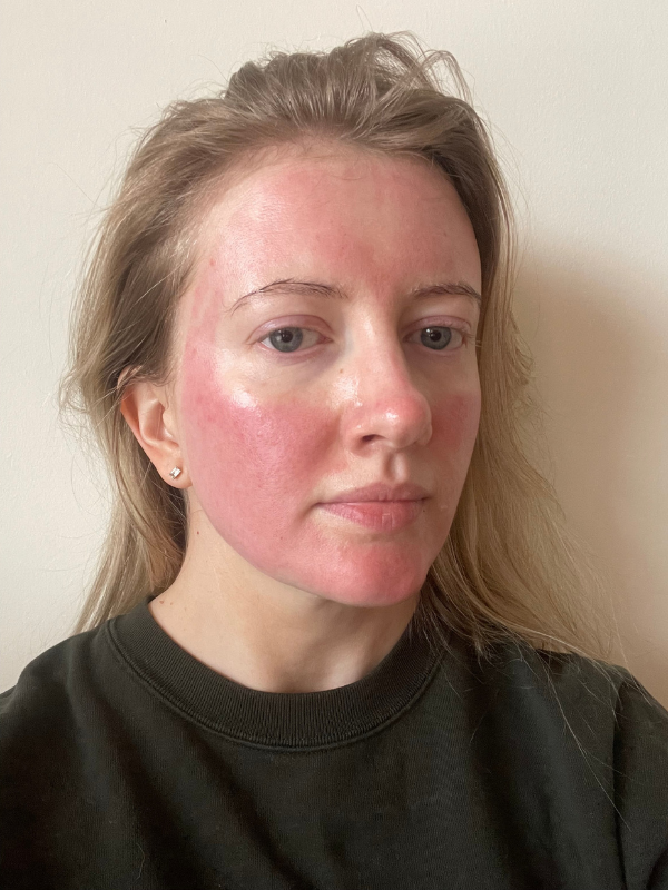 microneedling results