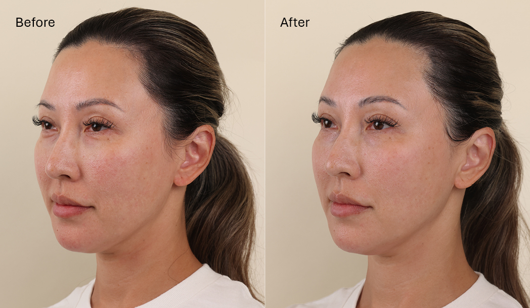 before and after results