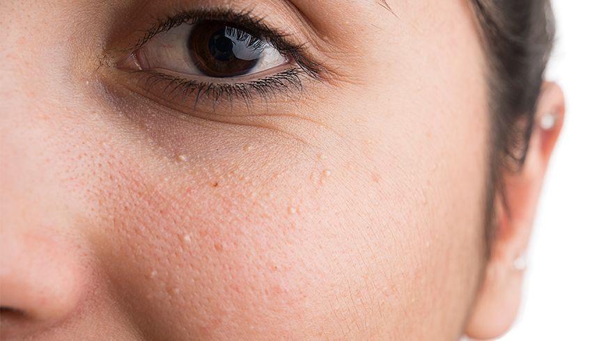 Closeup of milia on a woman's cheek - right below her eye