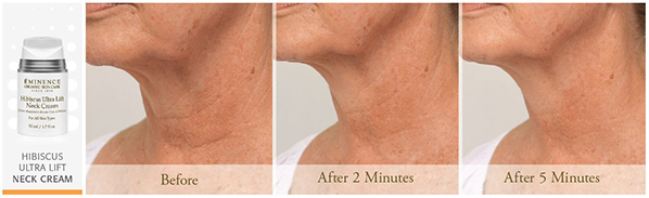 Before and after results using Eminence Organics Hibiscus Ultra Lift Neck Cream