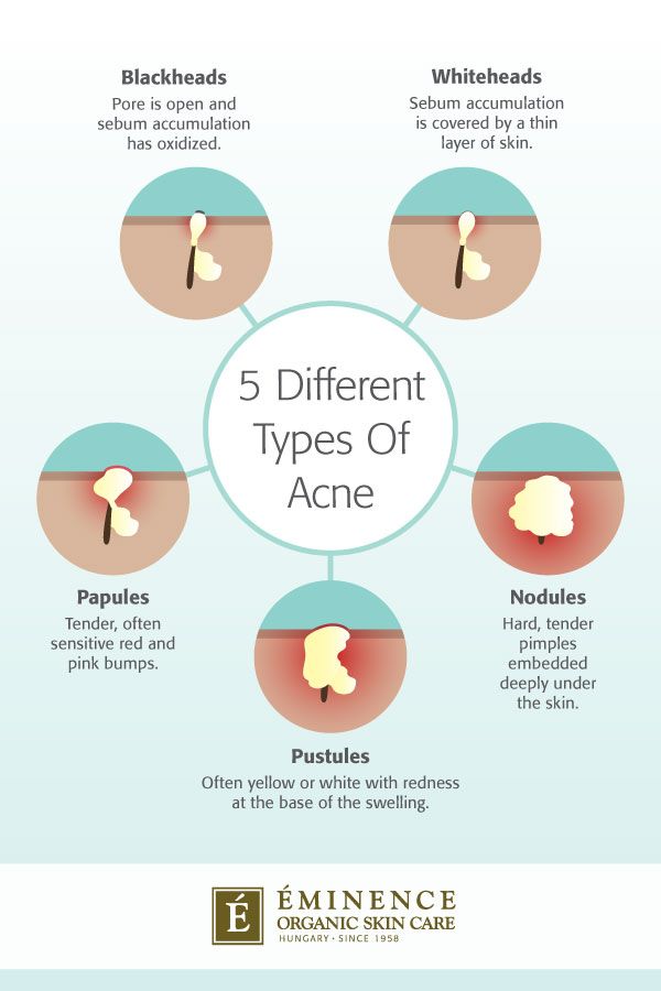 Eminence Organics infographic illustrating the differences between 5 types of acne