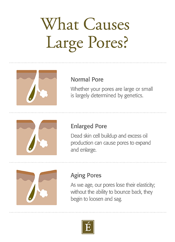 What Causes Large Pores Infographic