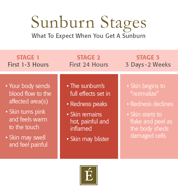 Sunburn Stages Infographic