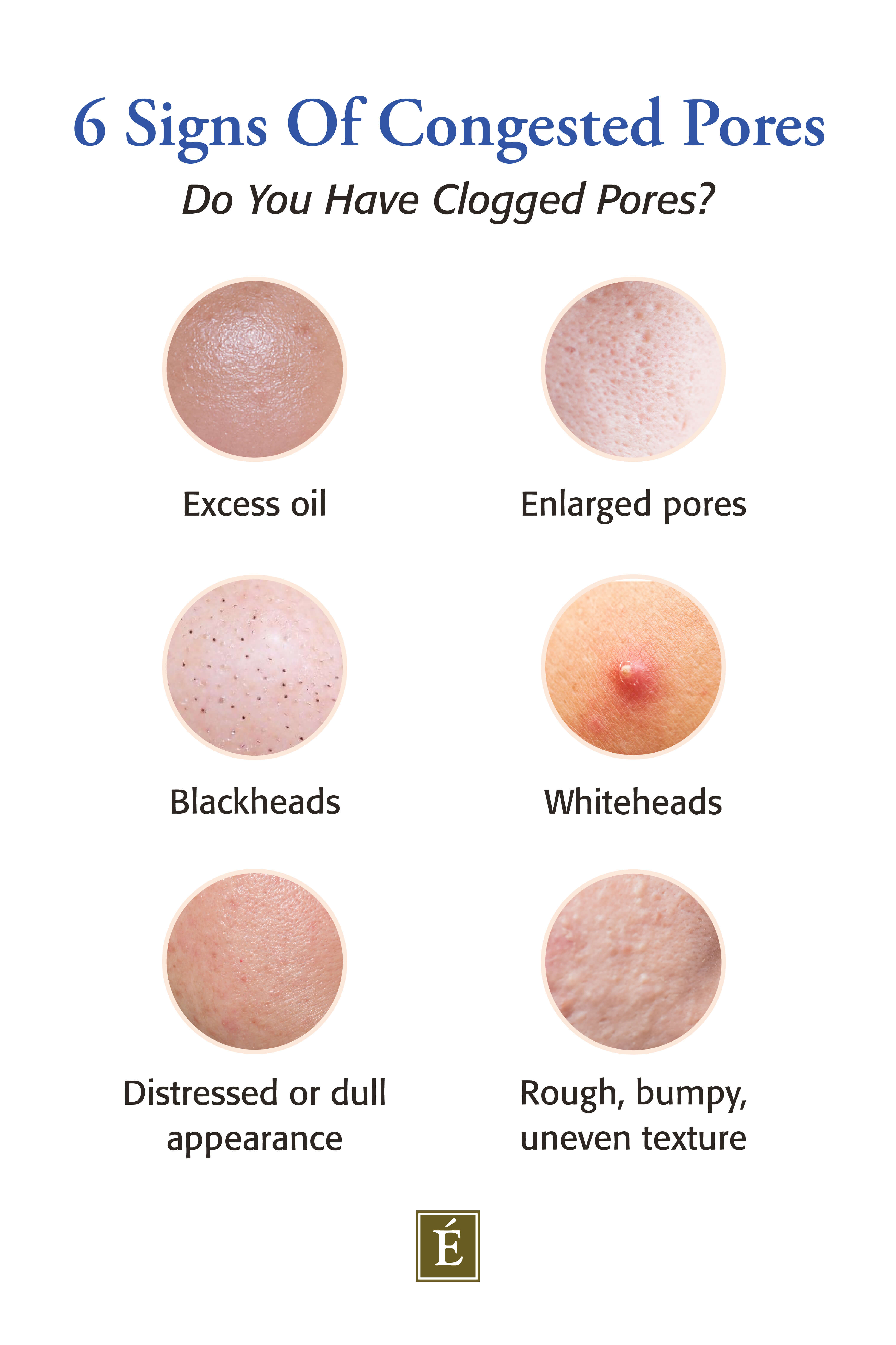 Signs of congested pores