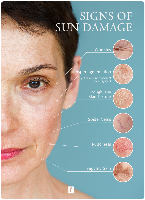 11 Common Types Of Sun Damaged Skin (See Pictures)