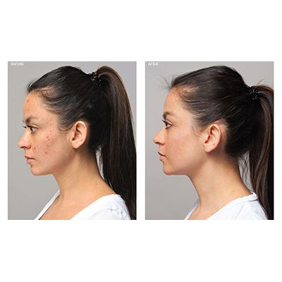 Acne Advanced 3-Step Treatment System